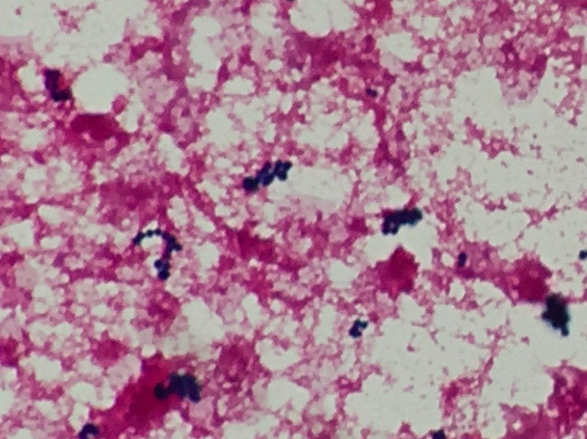 Staphylococcus lugdunensis　〔黄色ブドウ球菌なCNS〕