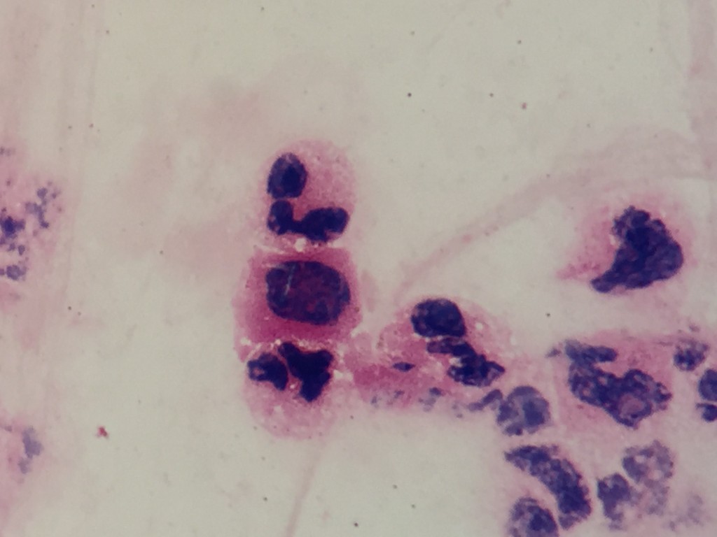 Mycobacterium tuberculosis　〔Ghost Bacillus：結核〕